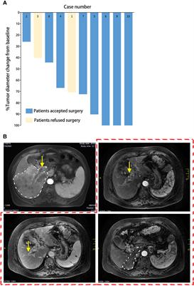 Surgery After Conversion Therapy With PD-1 Inhibitors Plus Tyrosine Kinase Inhibitors Are Effective and Safe for Advanced Hepatocellular Carcinoma: A Pilot Study of Ten Patients